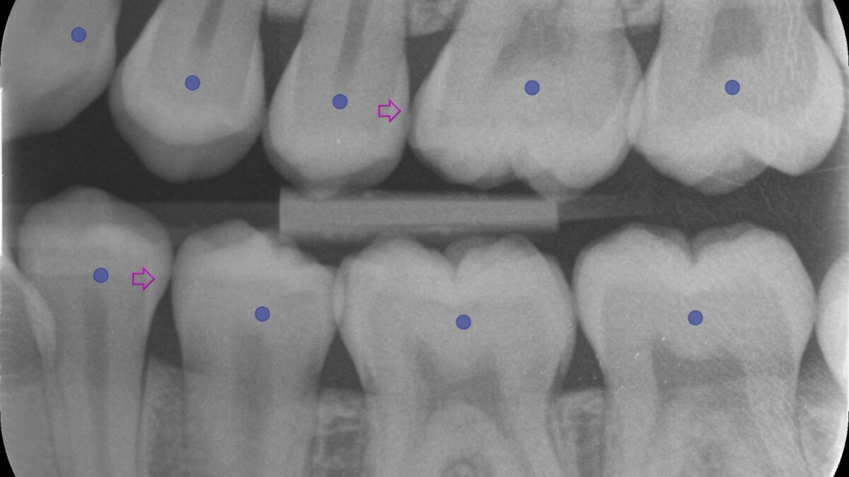 Scottish dentists test AI to identify tooth decay early