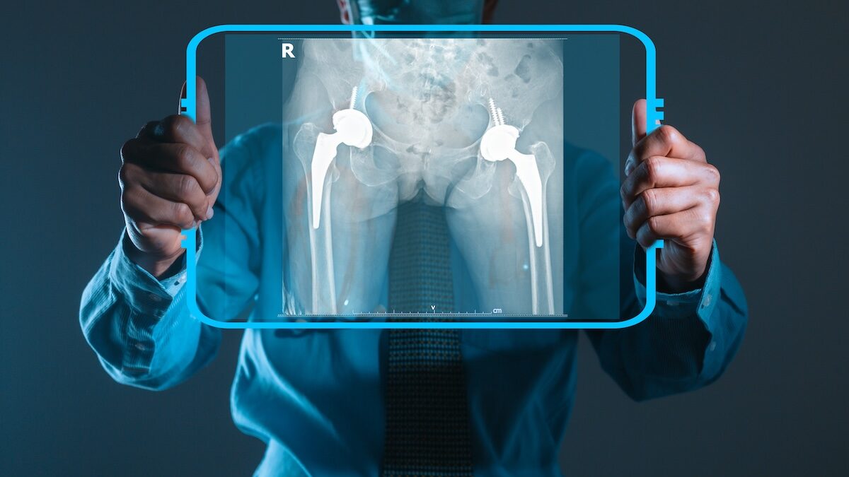 AI can cut waiting times for hip replacement surgery, Aberdeen study shows