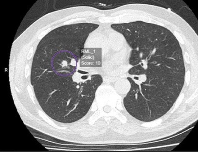 NHS Greater Glasgow & Clyde to play leading role in UK study using AI to improve lung cancer diagnosis